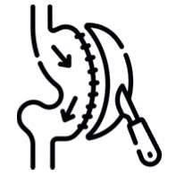icono gastroplastia